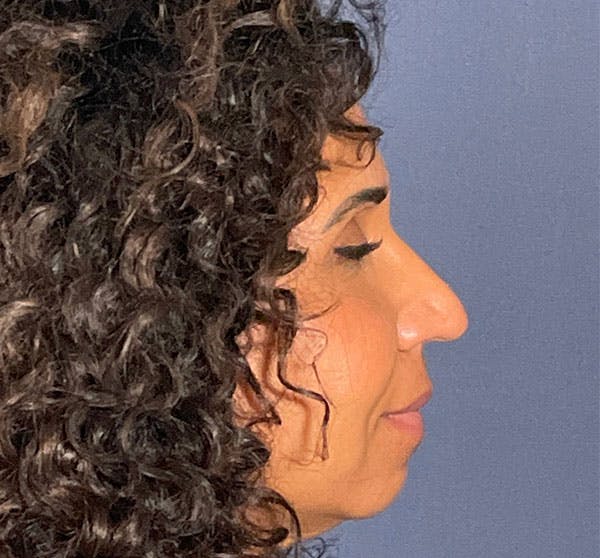  Liquid Rhinoplasty Before & After Gallery - Patient 161312986 - Image 1