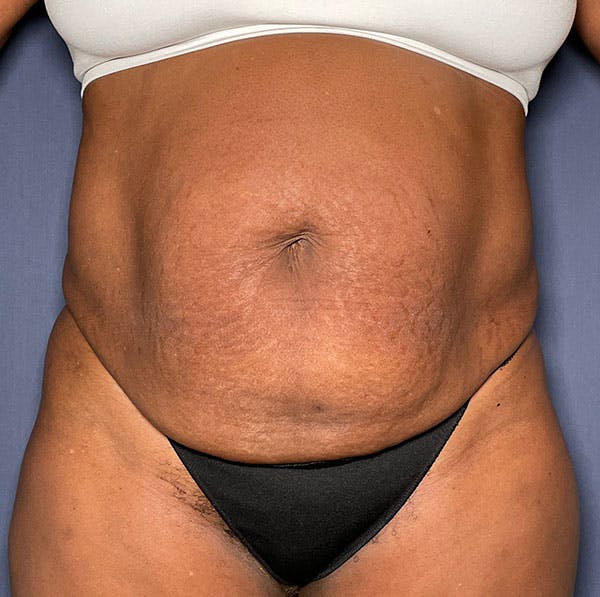 Tummy Tuck (Abdominoplasty) Before & After Gallery - Patient 161313027 - Image 1