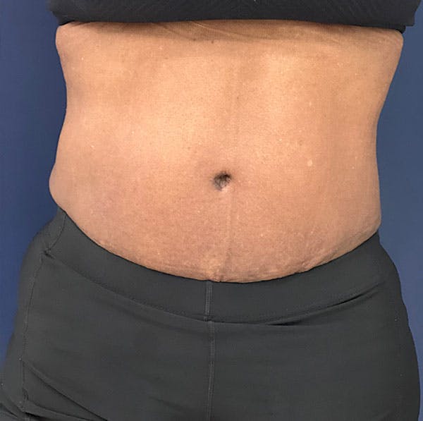 Tummy Tuck (Abdominoplasty) Before & After Gallery - Patient 161313027 - Image 2