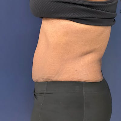 Tummy Tuck (Abdominoplasty) Before & After Gallery - Patient 161313027 - Image 4