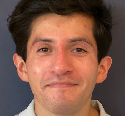  Liquid Rhinoplasty Before & After Gallery - Patient 145833089 - Image 4