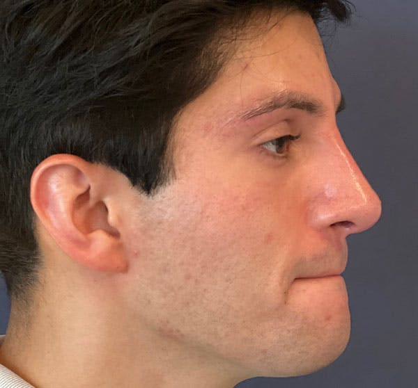  Liquid Rhinoplasty Before & After Gallery - Patient 145833089 - Image 6