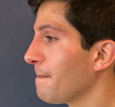  Liquid Rhinoplasty Before & After Gallery - Patient 145833089 - Image 8