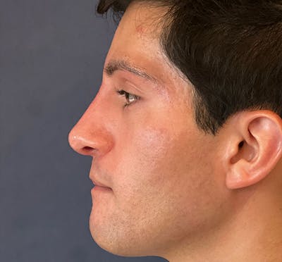  Liquid Rhinoplasty Before & After Gallery - Patient 145833089 - Image 2