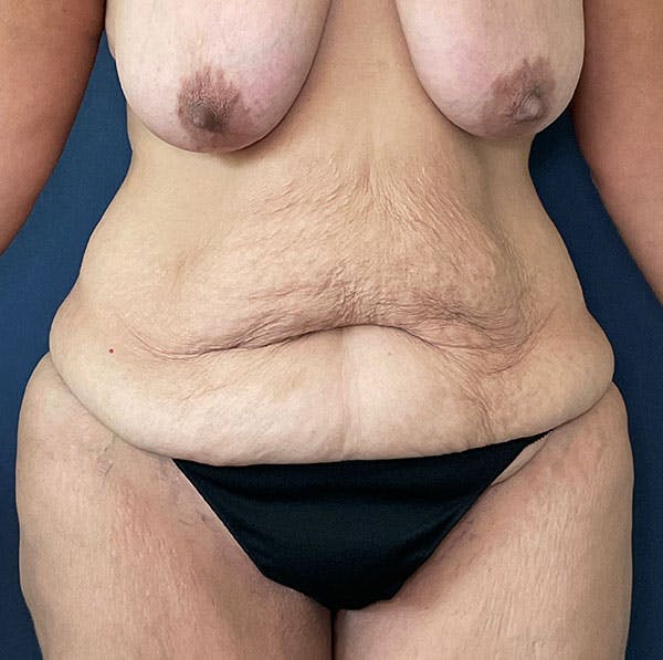 Tummy Tuck (Abdominoplasty) Before & After Gallery - Patient 161573629 - Image 1