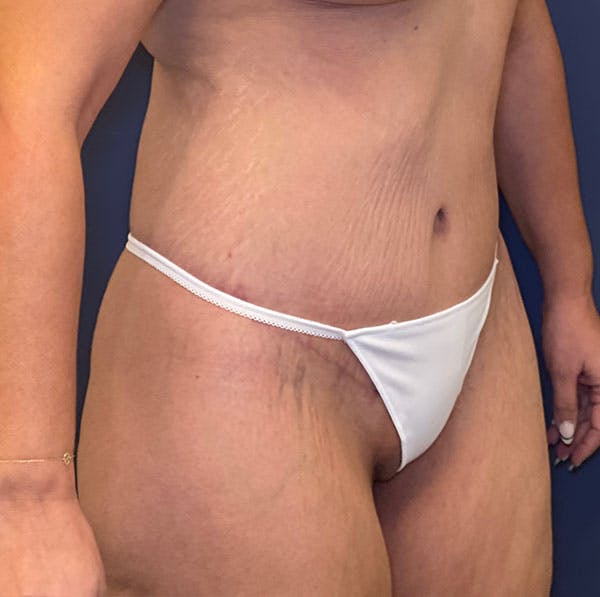 Tummy Tuck (Abdominoplasty) Before & After Gallery - Patient 161573629 - Image 4