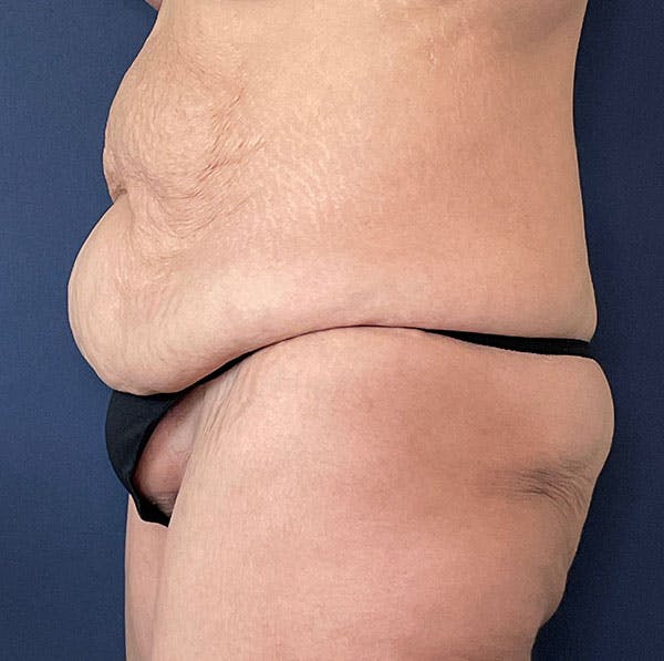 Tummy Tuck (Abdominoplasty) Before & After Gallery - Patient 161573629 - Image 5