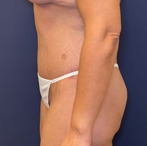 Tummy Tuck (Abdominoplasty) Before & After Gallery - Patient 161573629 - Image 6