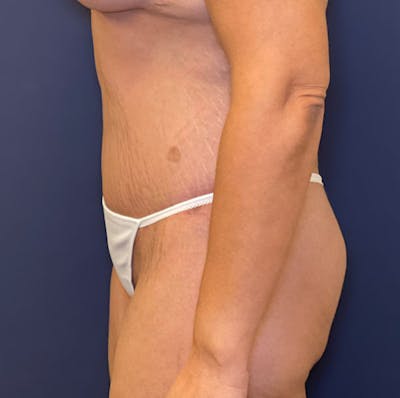 Tummy Tuck (Abdominoplasty) Before & After Gallery - Patient 161573629 - Image 6