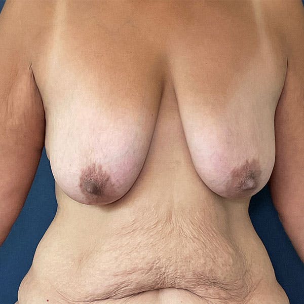 NaturaBra® Mastopexy Before & After Gallery - Patient 161573642 - Image 1