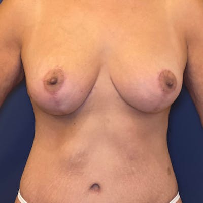 NaturaBra® Mastopexy Before & After Gallery - Patient 161573642 - Image 2