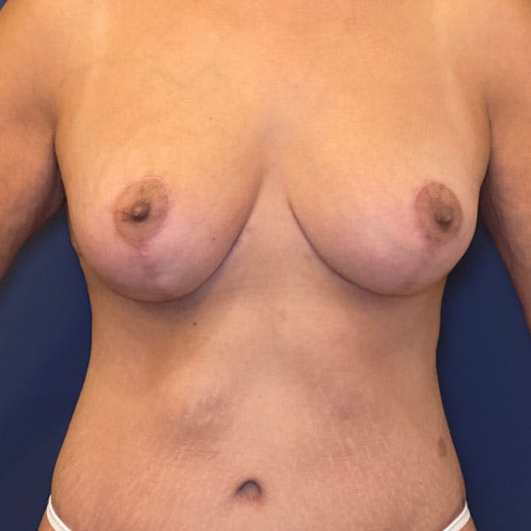NaturaBra® Mastopexy Before & After Gallery - Patient 161573642 - Image 2