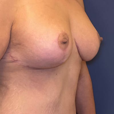 NaturaBra® Mastopexy Before & After Gallery - Patient 161573642 - Image 4