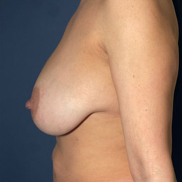 NaturaBra® Mastopexy Before & After Gallery - Patient 161579960 - Image 7