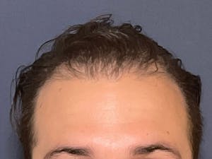 Before and After Hair Transplants in Long Island