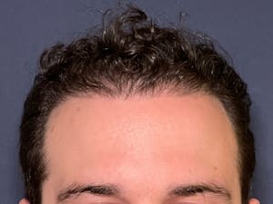 Before and After Hair Transplants in Long Island