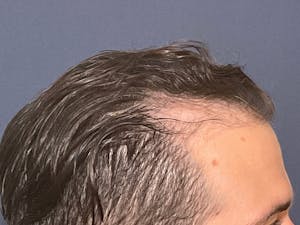 Before and After Hair Transplants in NYC