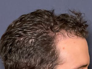 Before and After Hair Transplants in NYC
