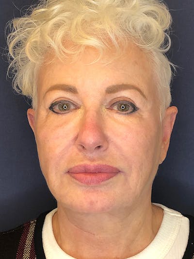 Facelift Before & After Gallery - Patient 53230537 - Image 1