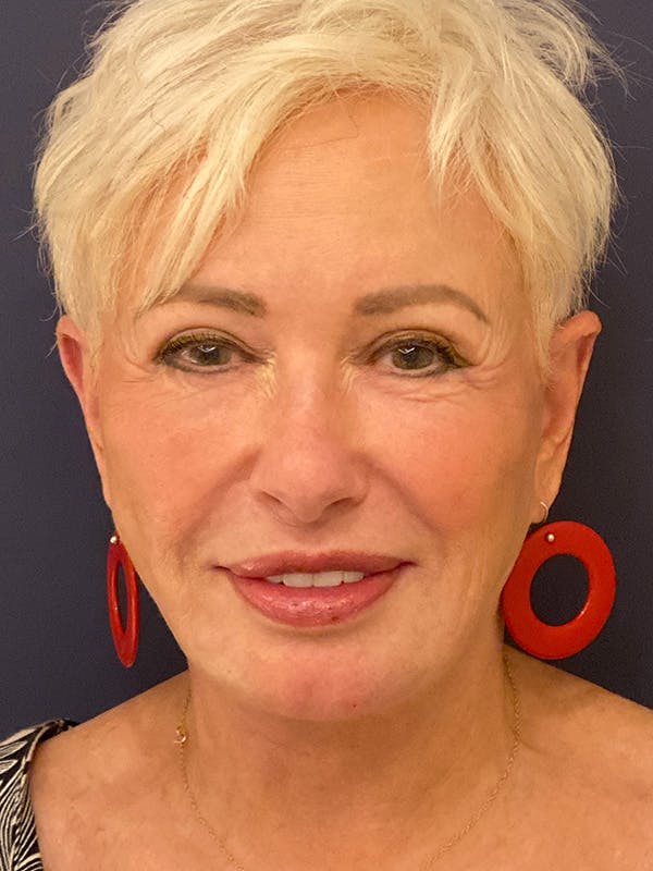 Facelift