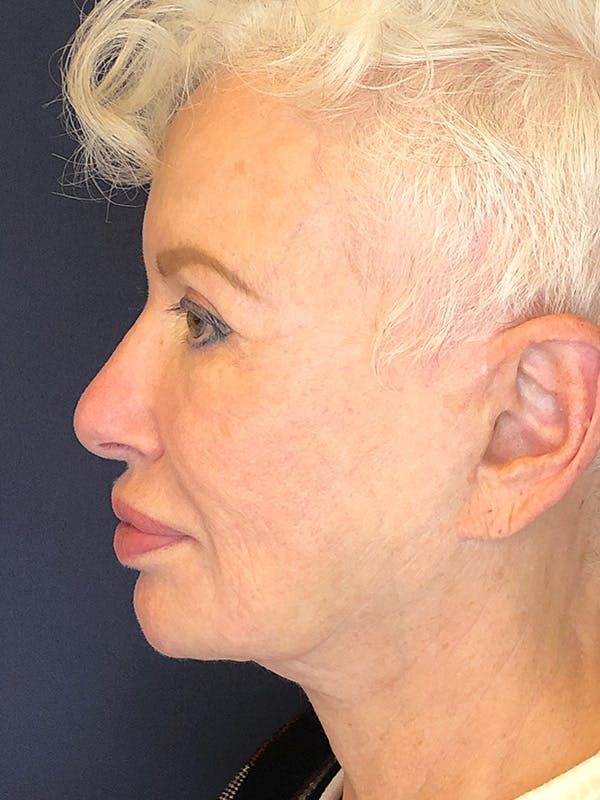 Facelift Before & After Gallery - Patient 53230537 - Image 5