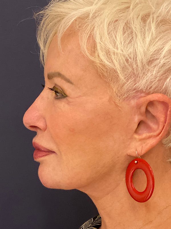 Neck Lift Before & After Gallery - Patient 141112690 - Image 6