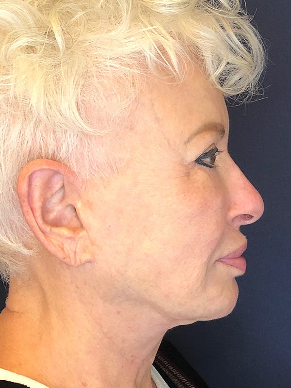 Facelift Before & After Gallery - Patient 53230537 - Image 9