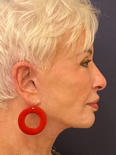 Neck Lift Before & After Gallery - Patient 141112690 - Image 10