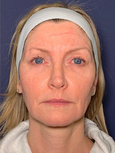 Facelift Before & After Gallery - Patient 53237660 - Image 1