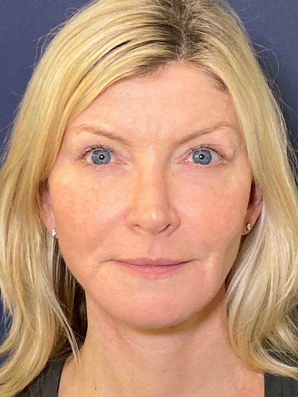 Facelift Before & After Gallery - Patient 53237660 - Image 2