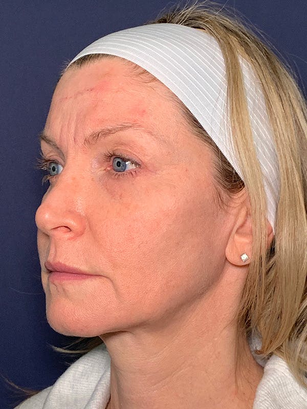 Facelift Before & After Gallery - Patient 53237660 - Image 3