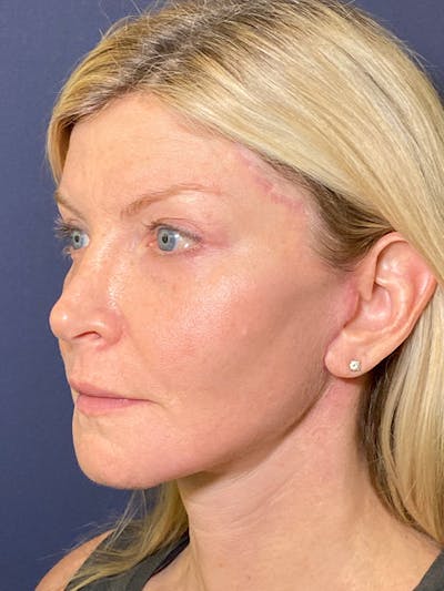 Neck Lift Before & After Gallery - Patient 141112692 - Image 4
