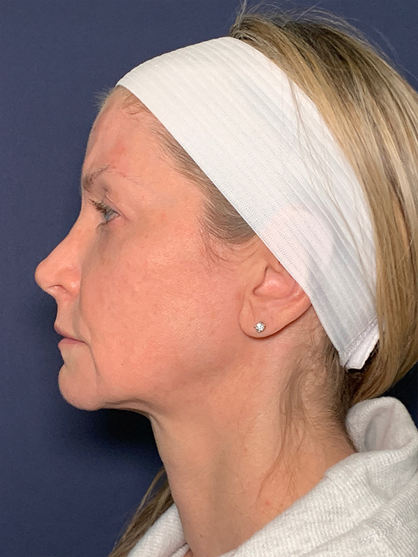 Patient 53237660 | Facelift Before and After | Alizadeh