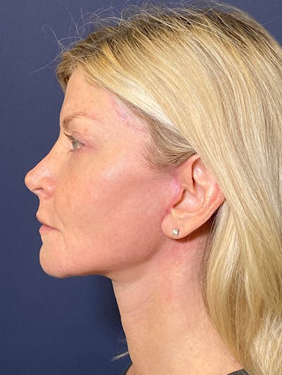 Facelift Before & After Gallery - Patient 53237660 - Image 6