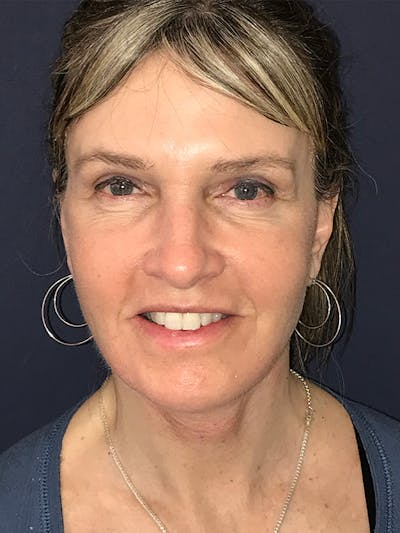 Facelift Before & After Gallery - Patient 270459 - Image 2