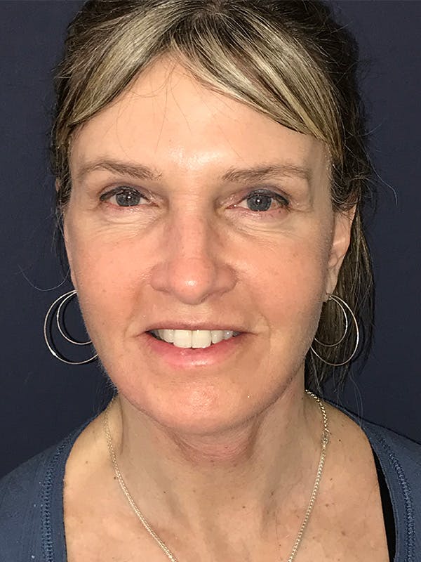 Facelift Before & After Gallery - Patient 270459 - Image 2