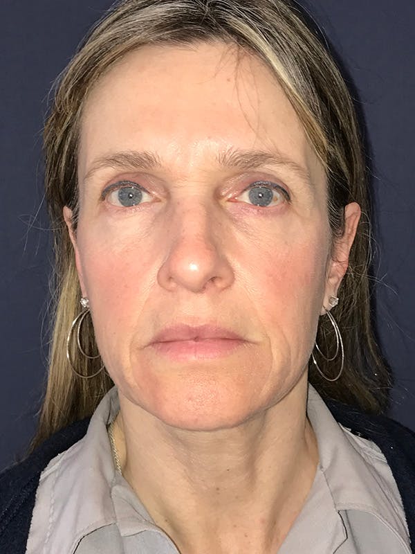 Facelift Before & After Gallery - Patient 270459 - Image 1