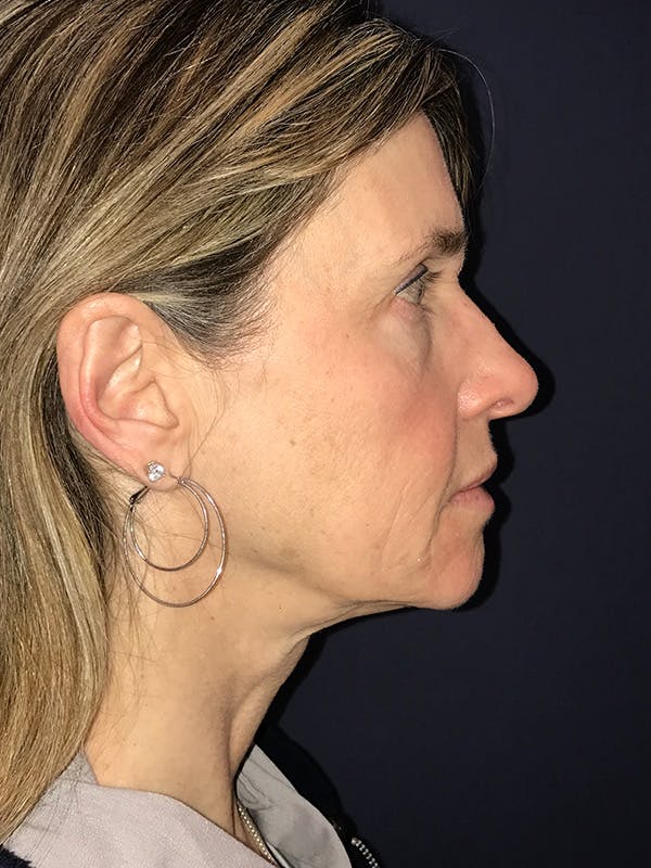 Facelift Before & After Gallery - Patient 270459 - Image 3