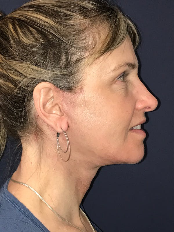 Neck Lift Before & After Gallery - Patient 174003307 - Image 4