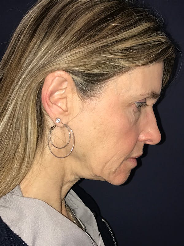 Facelift Before & After Gallery - Patient 270459 - Image 5