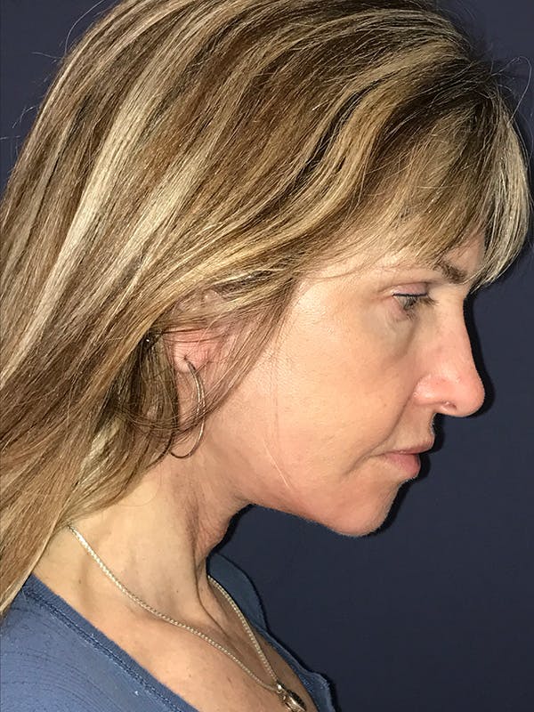 Neck Lift Before & After Gallery - Patient 174003307 - Image 6