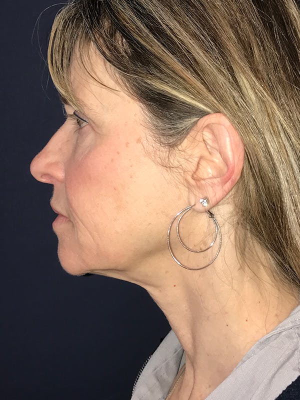 Neck Lift Before & After Gallery - Patient 174003307 - Image 7