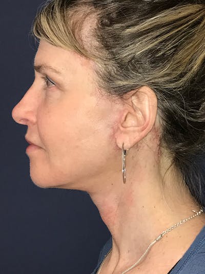 Facelift Before & After Gallery - Patient 270459 - Image 8