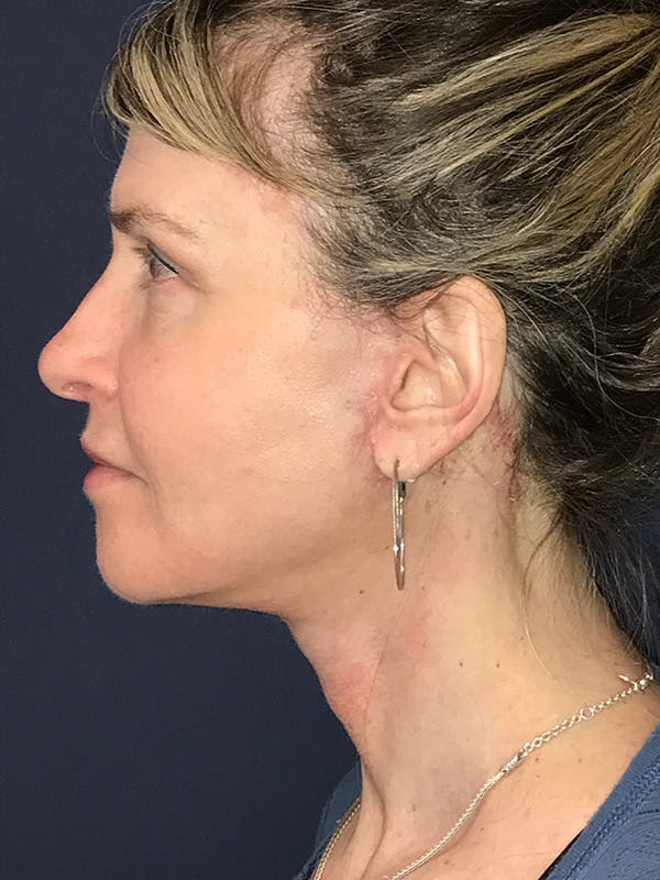 Neck Lift Before & After Gallery - Patient 174003307 - Image 8