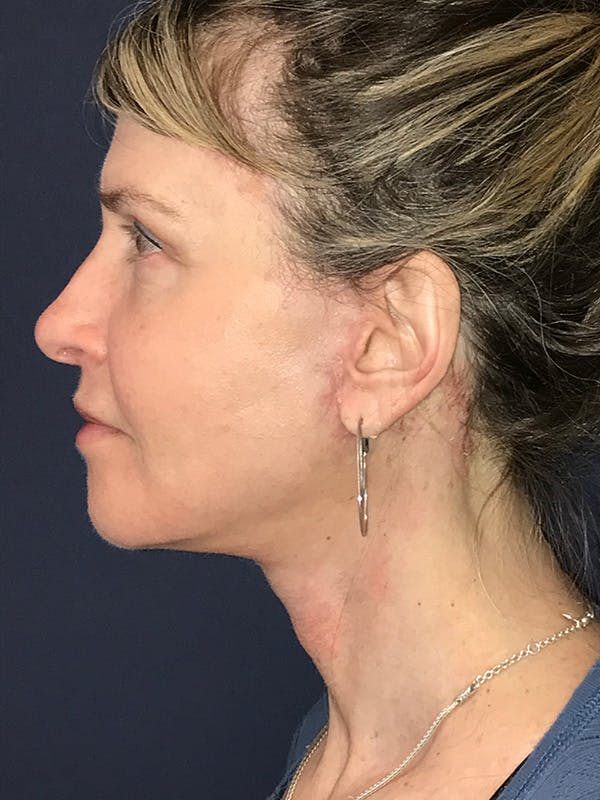 Facelift Before & After Gallery - Patient 270459 - Image 8