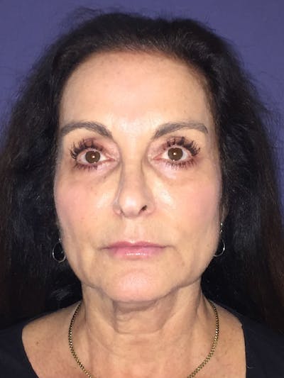 Neck Lift Before & After Gallery - Patient 174003200 - Image 1