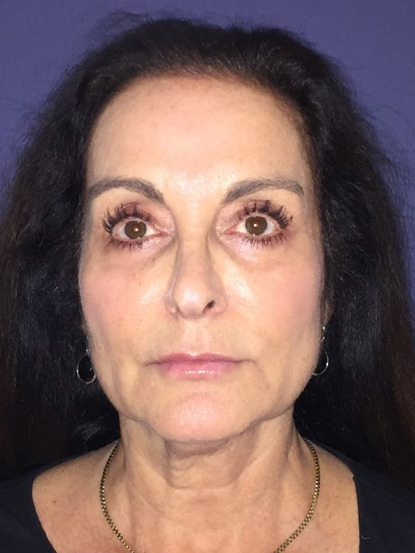 Facelift Before & After Gallery - Patient 174002995 - Image 1