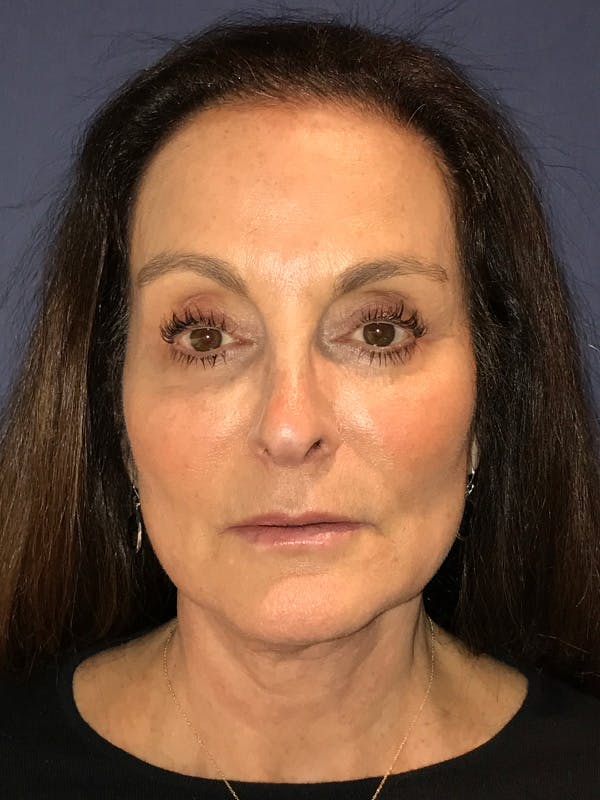Neck Lift Before & After Gallery - Patient 174003200 - Image 2