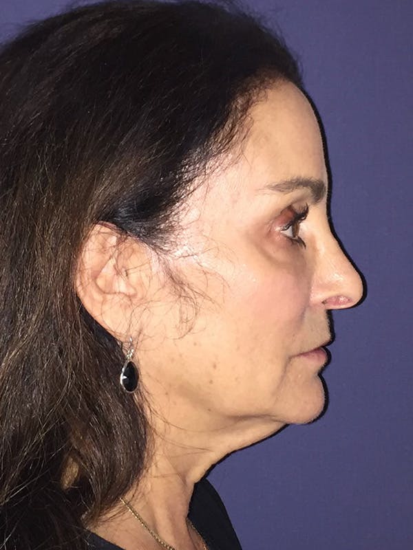 Neck Lift Before & After Gallery - Patient 174003200 - Image 3