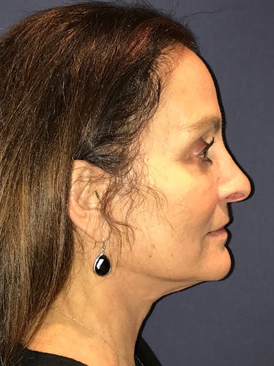 Facelift Before & After Gallery - Patient 174002995 - Image 4
